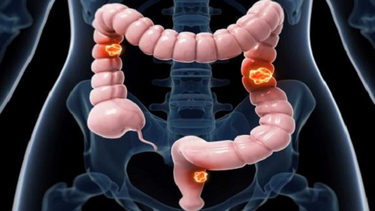 Tại sao ung thư đại tràng được gọi là Colon Cancer trong tiếng Anh?
