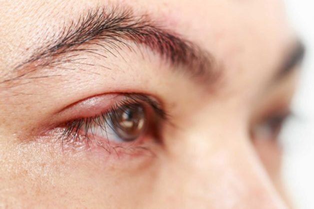 Viêm bờ mi mắt là căn bệnh thường gặp ở mọi đối tượng