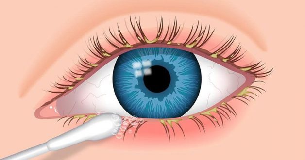 Viêm bờ mi mắt là căn bệnh thường gặp ở mọi lứa tuổi