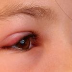 Nguyên nhân và cách điều trị hiệu quả viêm bờ mi mắt ở trẻ nhỏ