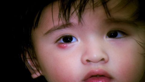 Chắp mắt trẻ em có nguy hiểm không?