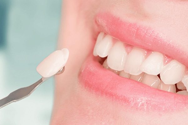Chi phí dán răng sứ hiện nay dao động từ hàng triệu cho đến hàng chục triệu đồng/răng