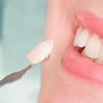 Chi phí dán răng sứ tại nha khoa bao nhiêu tiền?