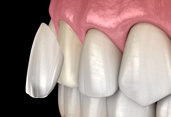 Dán răng sứ là phương pháp thẩm mỹ răng hiện đại sử dụng mặt sứ veneer để gắn lên trên bề mặt răng