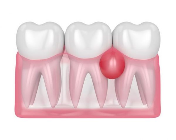 Áp xe răng là tình trạng nhiễm trùng răng miệng nặng do vi khuẩn tích tụ gây nên những ổ viêm, có mủ ở phần chân răng hoặc nướu răng