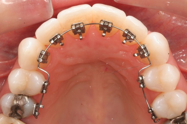Với phương pháp niềng răng mặt trong, mắc cài và dây cung sẽ được gắn ở mặt trong thân răng, do đó có tính thẩm mỹ cao