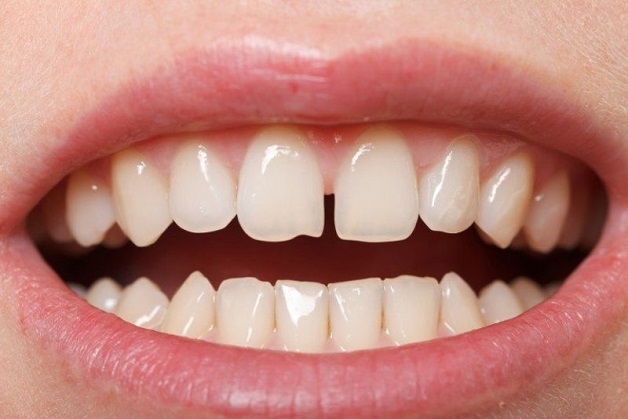 Răng thưa không chỉ ảnh hưởng đến thẩm mỹ mà còn tiềm ẩn nhiều nguy cơ gây hại tới sức khỏe răng miệng