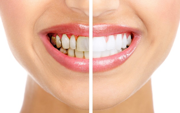 Tẩy trắng răng giúp bạn có được hàm răng trắng sáng, đều màu hơn rất nhiều so với ban đầu