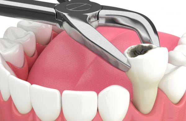 Răng cấm mắc bệnh lý nghiêm trọng ảnh hưởng tới tủy răng sẽ được bác sĩ chỉ định nhổ