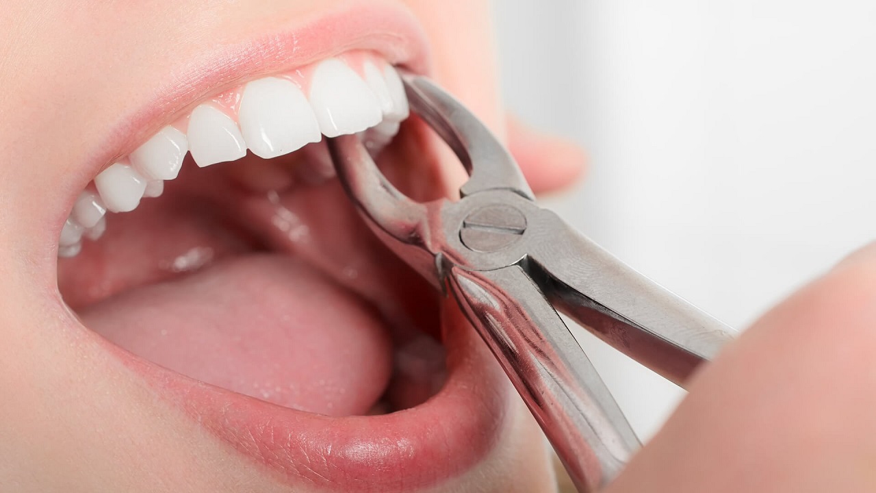 Làm sao để tìm cơ sở nha khoa uy tín và phù hợp để nhổ răng số 6?
