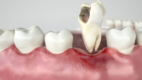Răng sâu nghiêm trọng, ảnh hưởng tới tủy và các cơ quan quanh răng cần được nhổ bỏ kịp thời