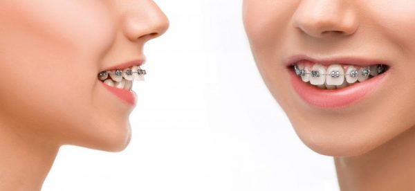 Giá niềng răng hàm trên cao bao nhiêu phụ thuộc nhiều vào phương pháp niềng