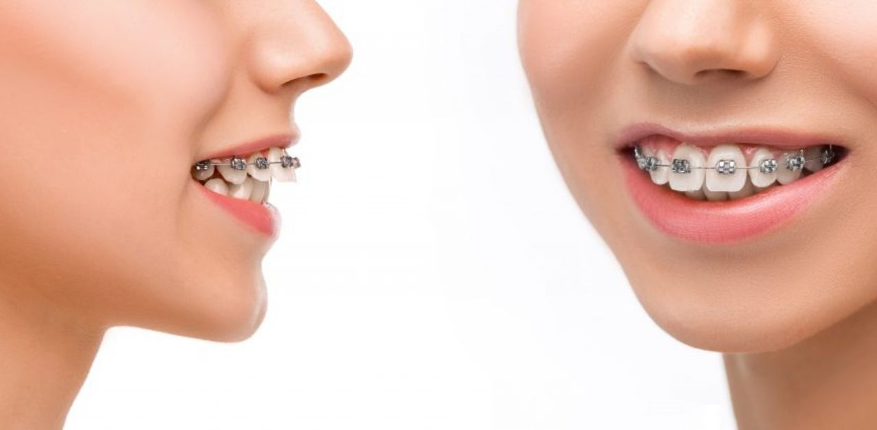 Đặc điểm và ưu điểm của từng loại niềng răng 1 hàm?

