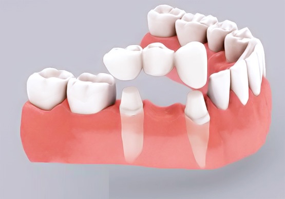Trồng răng sứ giúp cải thiện một số vấn đề răng miệng làm ảnh hưởng tới chức năng nhai và thẩm mỹ hàm răng