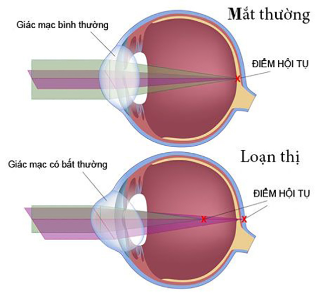 Cách Giảm Loạn Thị Hiệu Quả: Giải Pháp Tự Nhiên và Y Khoa