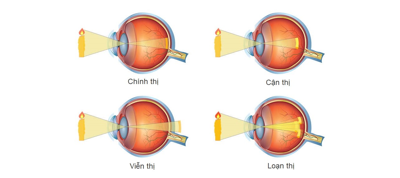 hiện tượng hình ảnh hội tụ ở mắt bị mắc khúc xạ