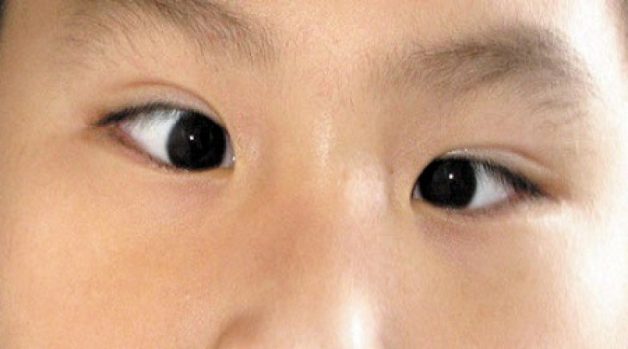 Nguyên nhân, dấu hiệu và cách điều trị hiệu quả mắt lác