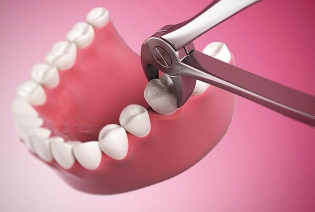 Với thắc mắc nhổ răng cấm giá bao nhiêu, câu trả lời là tùy từng phương pháp nhổ răng sẽ có mức giá khác nhau
