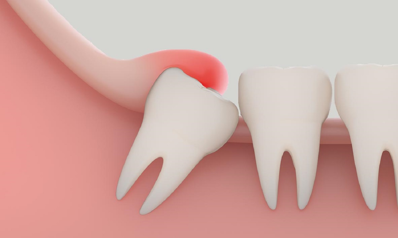 Chi phí nhổ răng hàm sâu dao động trong khoảng bao nhiêu tiền?
