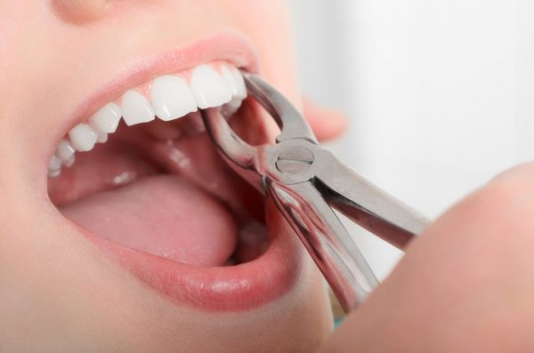 Nhổ răng hết bao nhiêu tiền còn phụ thuộc vào những yếu tố như: Loại răng cần nhổ, phương pháp nhổ, tay nghề của bác sĩ...