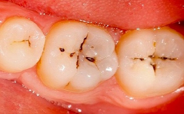Sâu răng có thể dễ dàng nhận biết qua dấu hiệu xuất hiện lỗ nhỏ hoặc các lỗ hổng ở trên bề mặt răng
