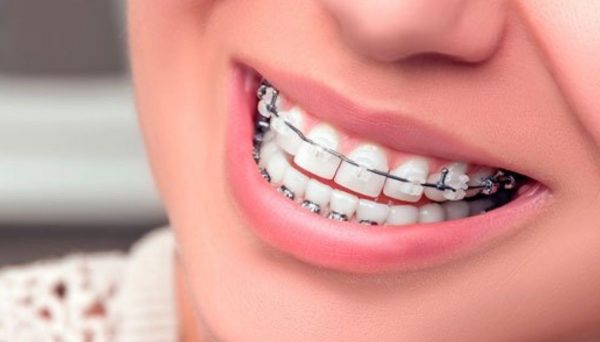 Có rất nhiều phương pháp niềng răng chỉnh nha phù hợp để điều chỉnh sự sai lệch của răng cửa hiện nay