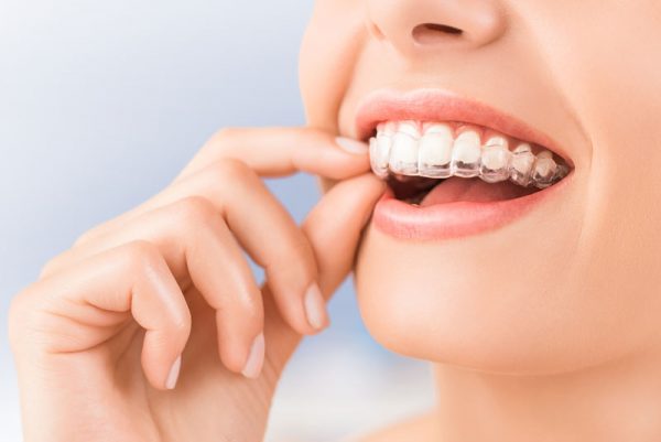Không thể niềng riêng 4 răng cửa mà phải niềng cả hàm để đảm bảo hiệu quả cũng như an toàn khi chỉnh nha