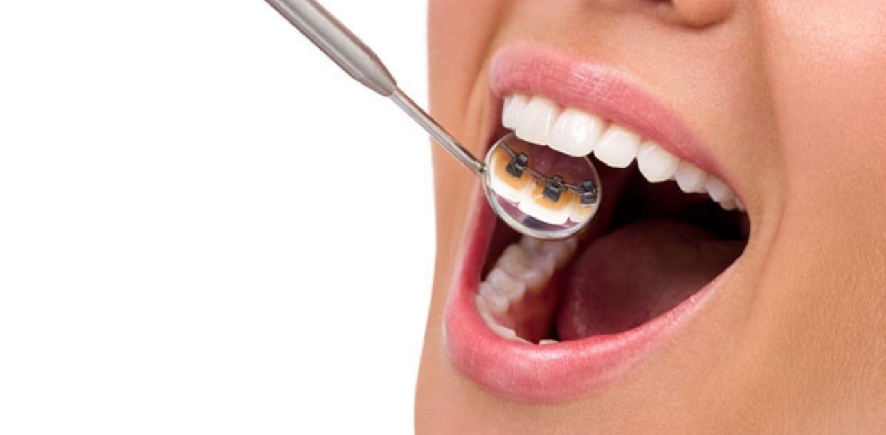 Làm thế nào để chăm sóc mắc cài trong quá trình niềng răng mắc cài mặt trong?
