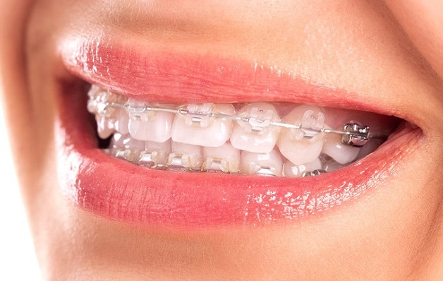 Niềng răng hô bao nhiêu tiền phụ thuộc vào phương pháp niềng răng khách hàng lựa chọn