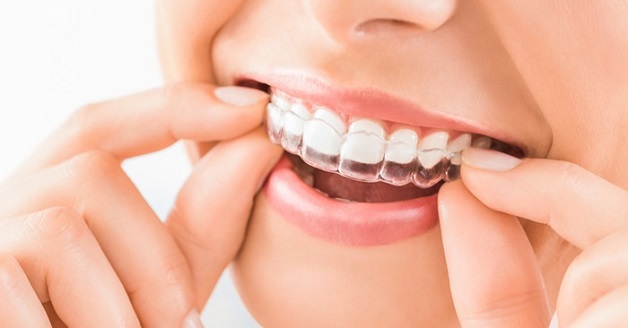 Niềng răng Invisalign là phương pháp niềng răng hiện đại nhất hiện nay với nhiều ưu điểm vượt trội.
