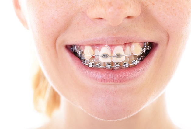 Niềng răng khểnh không chỉ mang lại nụ cười đẹp mà còn có tác dụng bảo vệ sức khỏe răng miệng