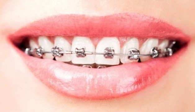 Niềng răng là sự lựa chọn phù hợp nhất dành cho những khách hàng muốn cải thiện hàm răng nhiều khiếm khuyết