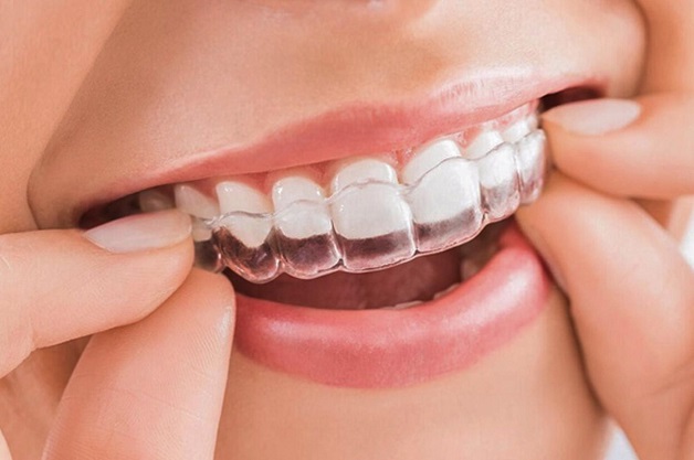 Với thắc mắc niềng răng khoảng bao nhiêu tiền, mỗi phương pháp niềng răng sẽ sở hữu mức chi phí khác nhau