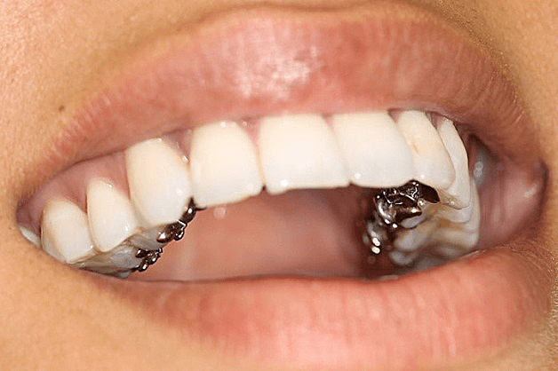 Niềng răng mặt trong bao nhiêu tiền phụ thuộc vào những yếu tố như địa chỉ thực hiện cũng như mức độ phức tạp của răng