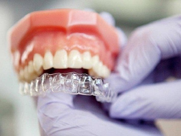 Niềng răng trong suốt giá bao nhiêu phụ thuộc vào số lượng khay niềng được sử dụng ở mỗi ca chỉnh nha