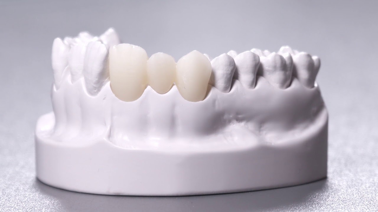 Răng sứ cercon có tuổi thọ là bao lâu?
