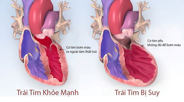 Suy tim sung huyết: Nguyên nhân, chẩn đoán và điều trị | TCI Hospital