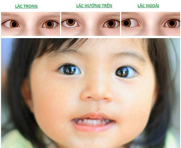 lác mắt là biến chứng tật khúc xạ