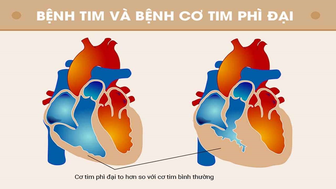 Bệnh cơ tim phì đại: Nguyên nhân, triệu chứng, điều trị | TCI Hospital