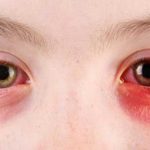 Tổng hợp những phương pháp điều trị đau mắt hột hiệu quả