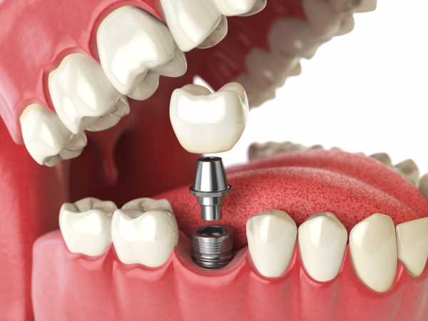 Trồng răng bằng phương pháp cấy ghép Implant