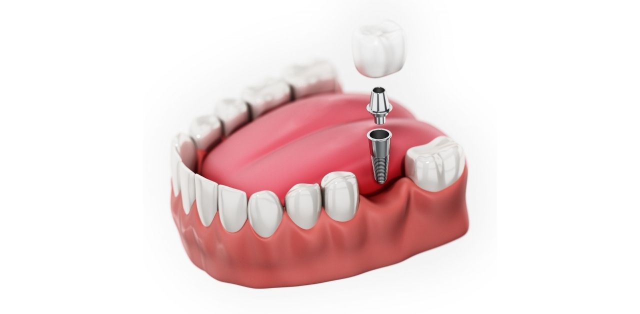 Điều trị trồng răng cấm có đau không?
