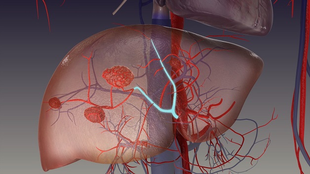U mạch máu - U ở gan thường gặp