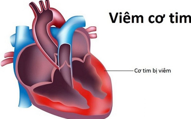 viêm cơ tim là gì
