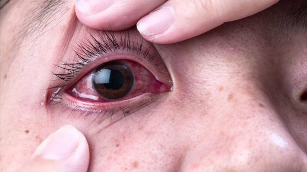 Mắt đỏ, sưng là triệu chứng dễ nhận biết khi mắc bệnh.