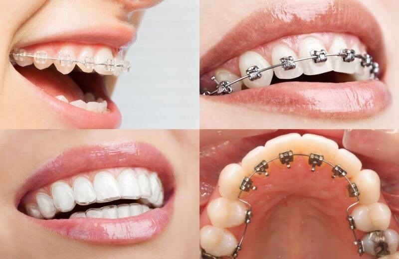 4 phương pháp niềng răng phổ biến: niềng bằng mắc cài sứ, niềng răng bằng mắc cài kim loại truyền thống, niềng răng bằng khay trong suốt, niềng răng mắc cài mặt trong