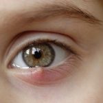 Cách chữa trị lẹo mắt ở trẻ em hiệu quả