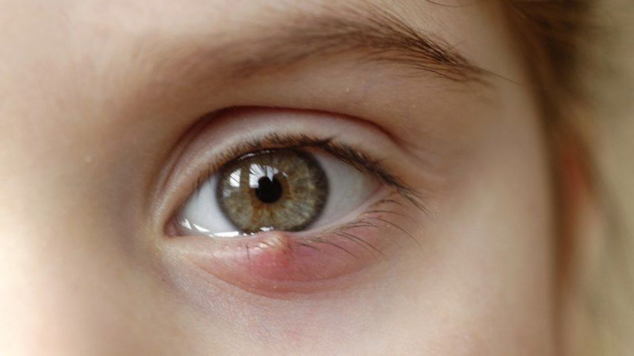 Trẻ em nên được chăm sóc như thế nào khi bị lẹo mắt?
