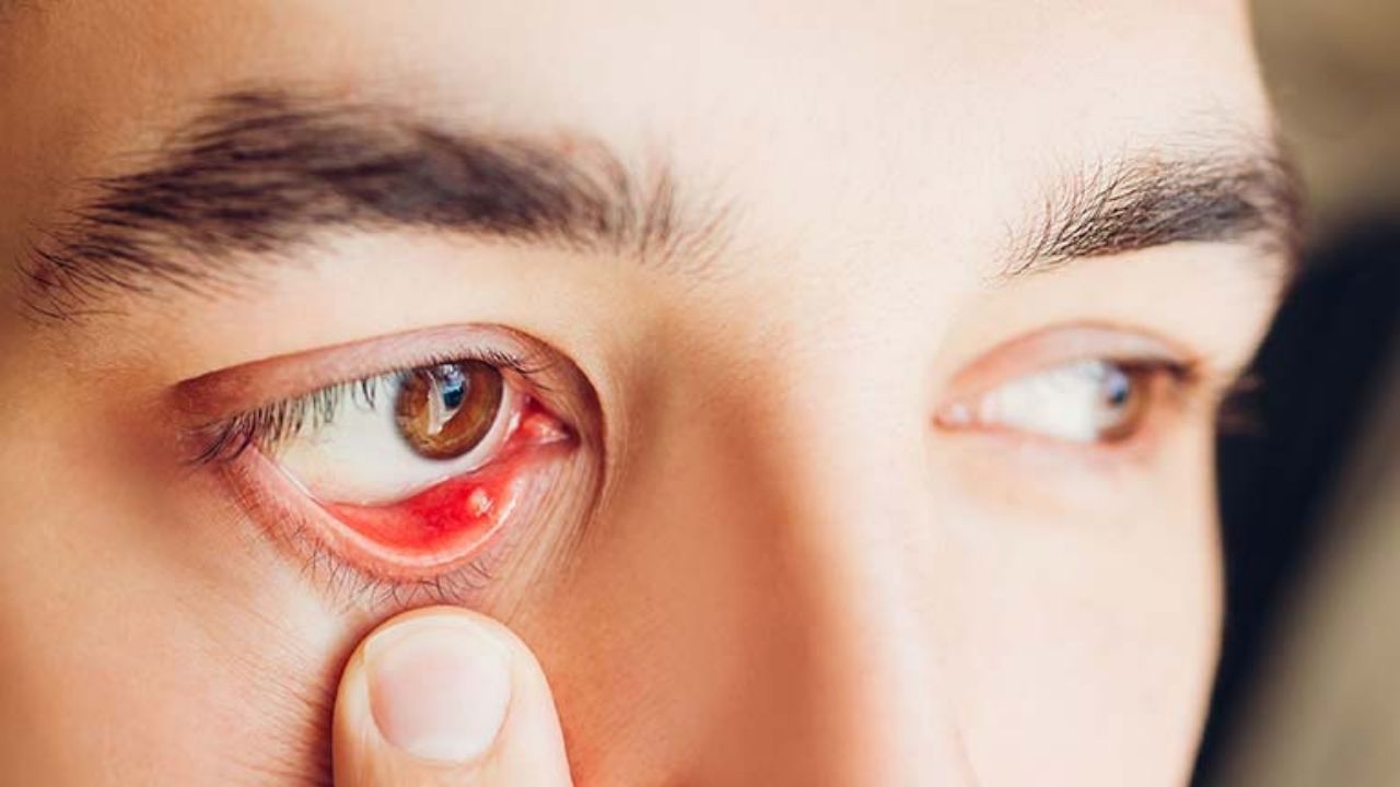 Những triệu chứng chắp mắt là như thế nào?
