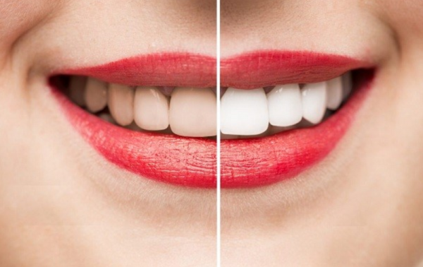 Tẩy trắng răng khắc phục hiệu quả tình trạng xỉn màu, ố vàng của răng